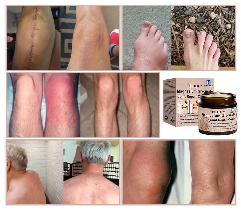 ✨ ODALIT™ Magnesium Glycinate Joint Repair Cream (Effective relief for arthritis, nerve pain, rheumatic conditions, sports injuries, and muscle spasms)✨