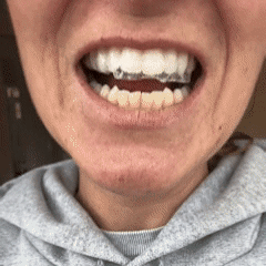 🥇 LBMLBM™ 7-Day Teeth Whitening Strips | Non-Slip Dry Strip Technology - Gentle, Fast Whitening for a Brighter, Confident Smile